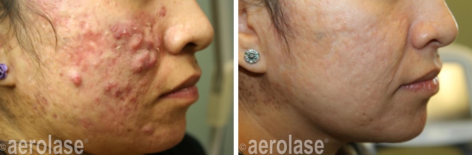 Acne Michael Gold After 5 Treatments