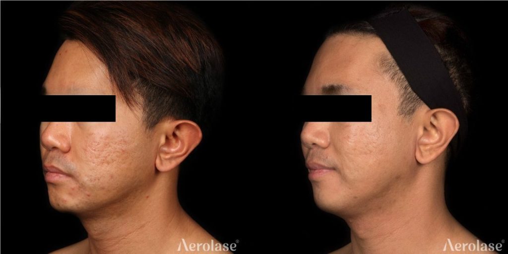 Acne Scars (Face) Jason Emer MD