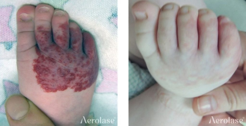Hemangioma (Foot) Dr. Gulia Kasimova