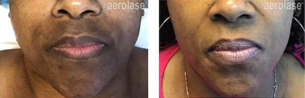 Melasma SOC Tiffany Crews 5 Tx