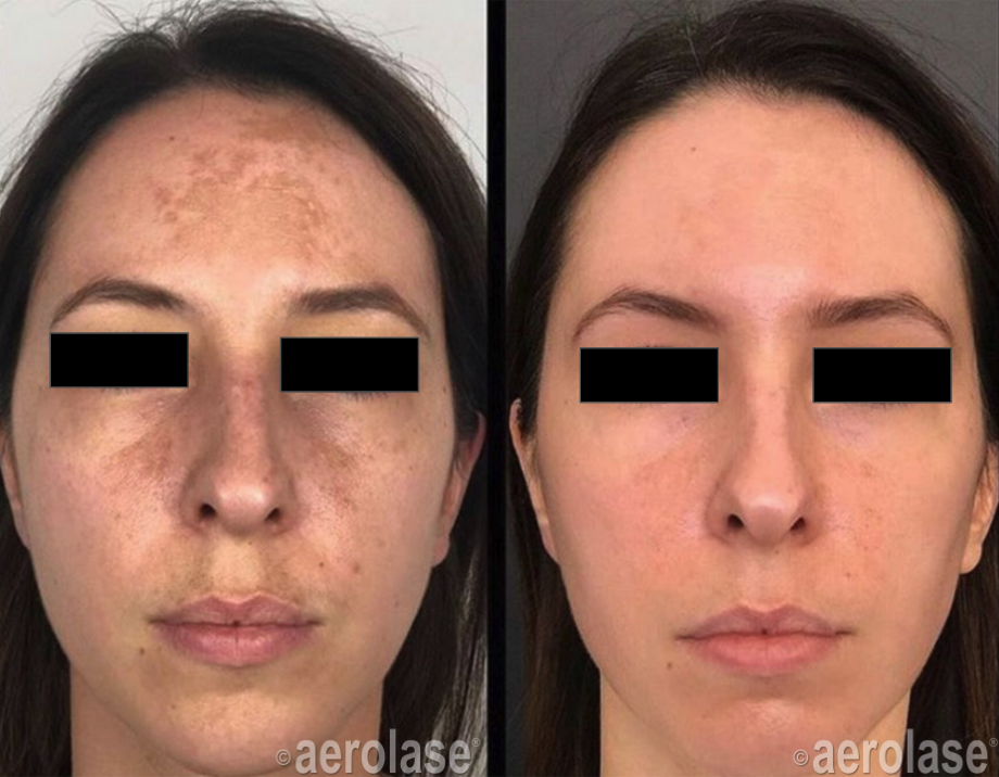 Melasma One Treatment Avanti Aesthetic Academy