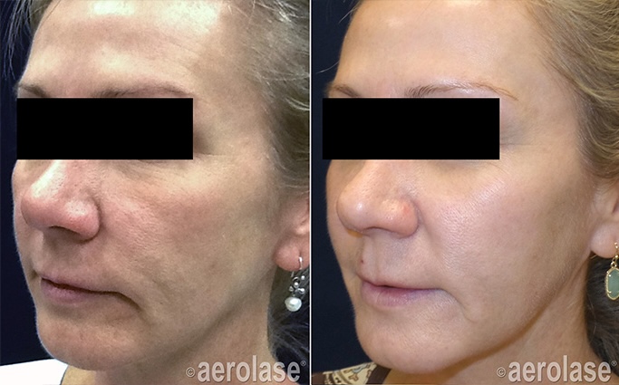 Neo Rejuvenation After 4 Treatments Kevin Pinski MD