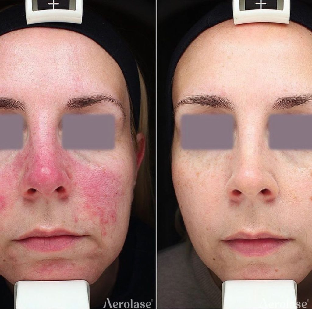Rosacea La Derma Beograd
