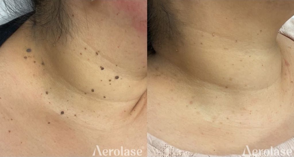 Skin Tags Luminescence Aesthetics